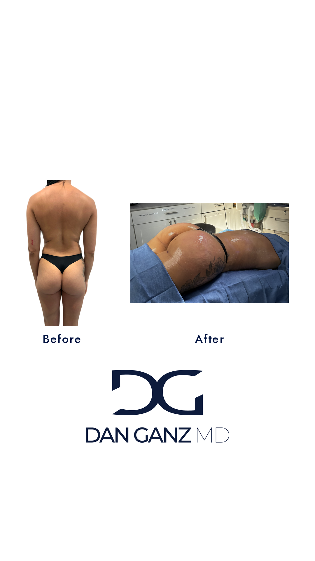 Brazilian butt lift before and after result by Dr. Dan Ganz, Miami