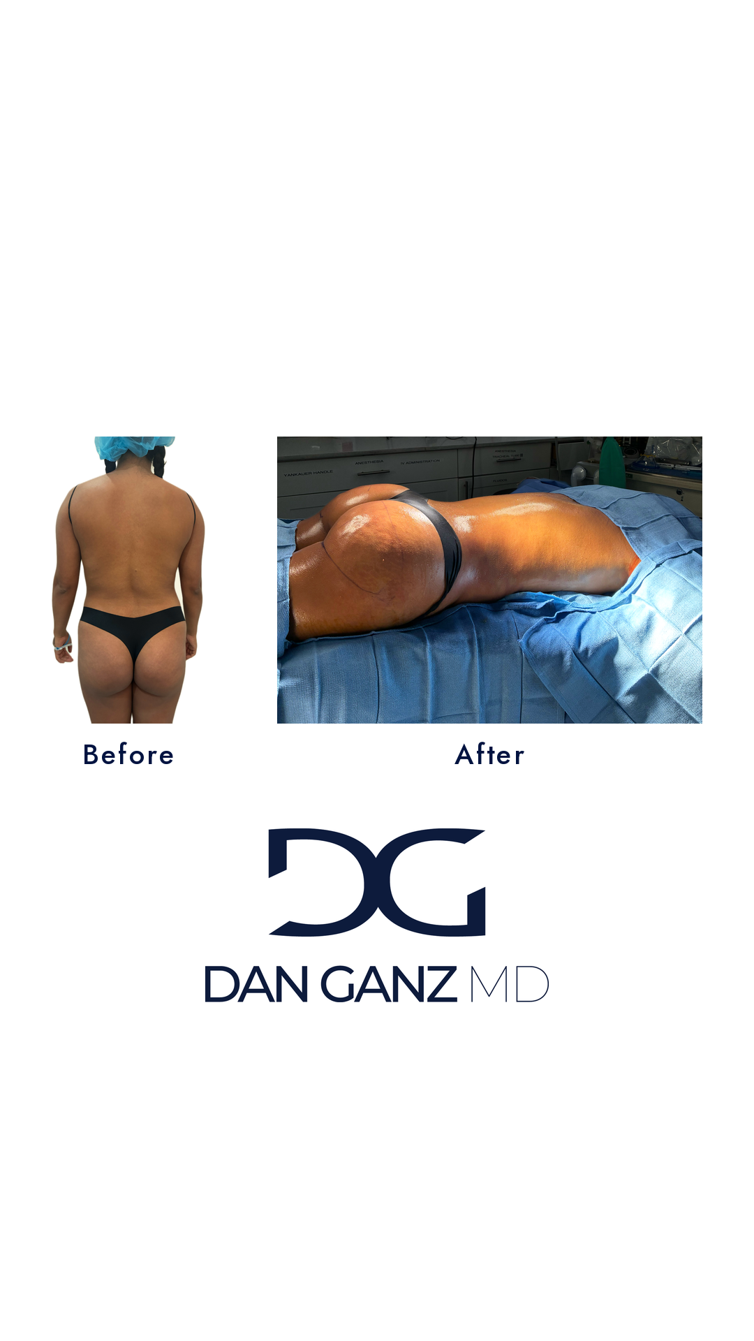 Brazilian butt lift before and after result by Dr. Dan Ganz, Miami