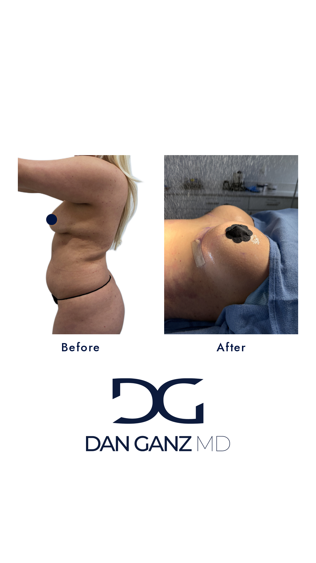 Breast augmentation before and after result by Dr. Dan Ganz, Miami