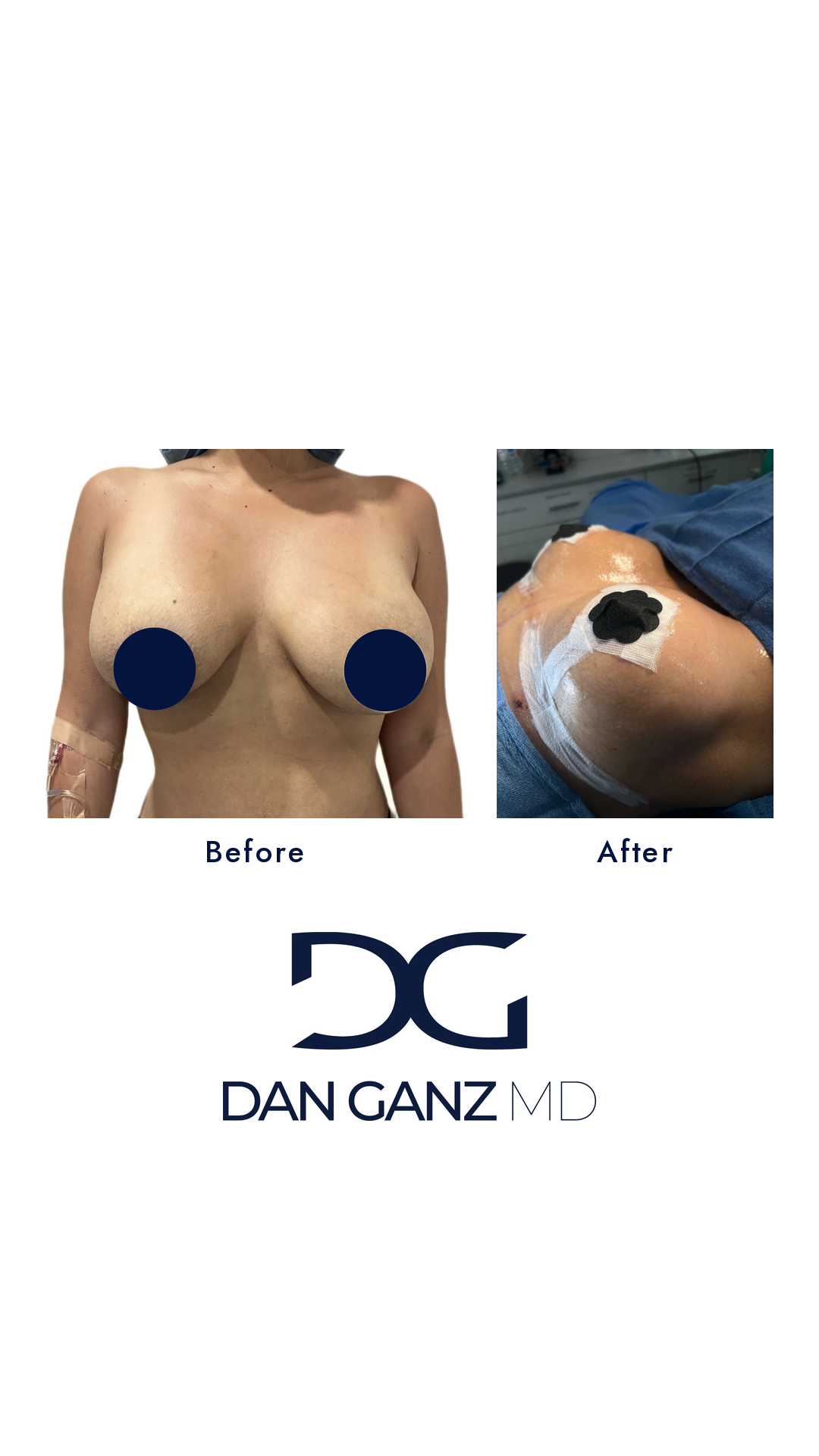Breast implant exchange with mastopexy before and after result by Dr. Dan Ganz, Miami