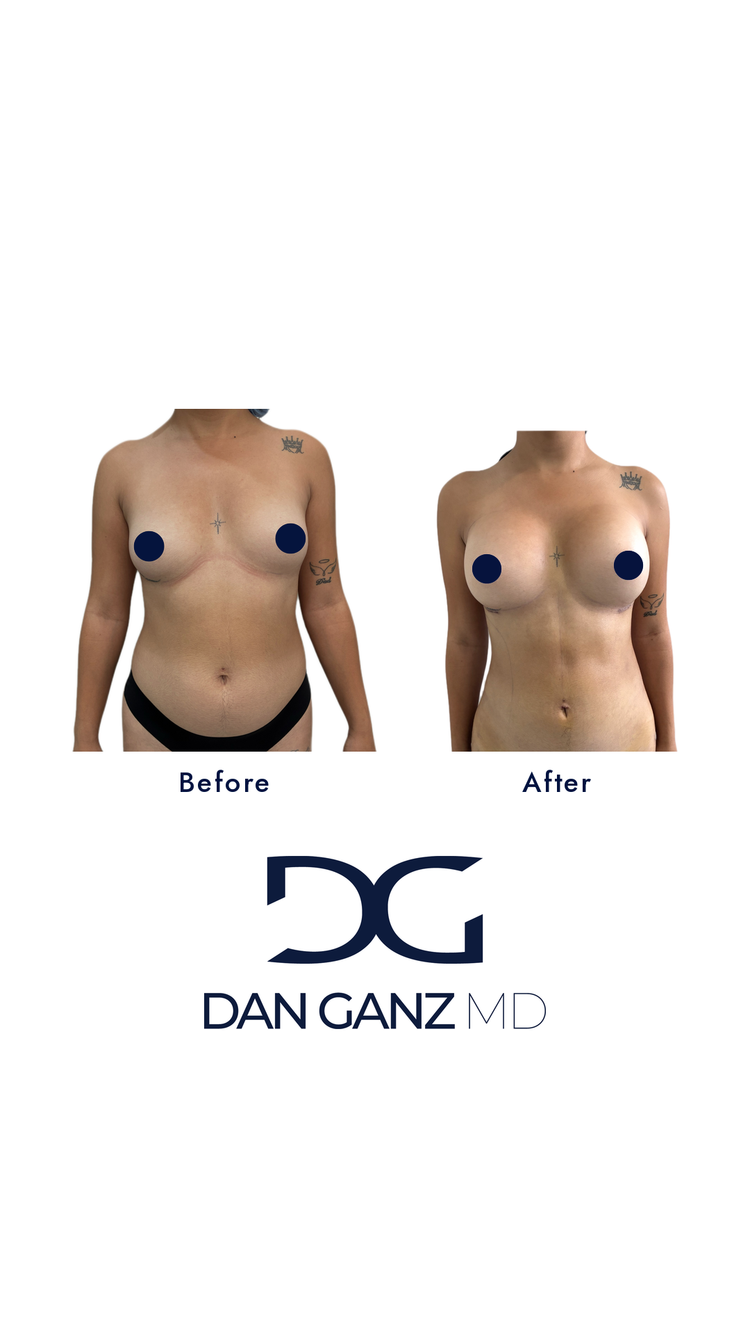 Breast augmentation healed before and after result by Dr. Dan Ganz, Miami